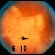 Posterior Uveitis